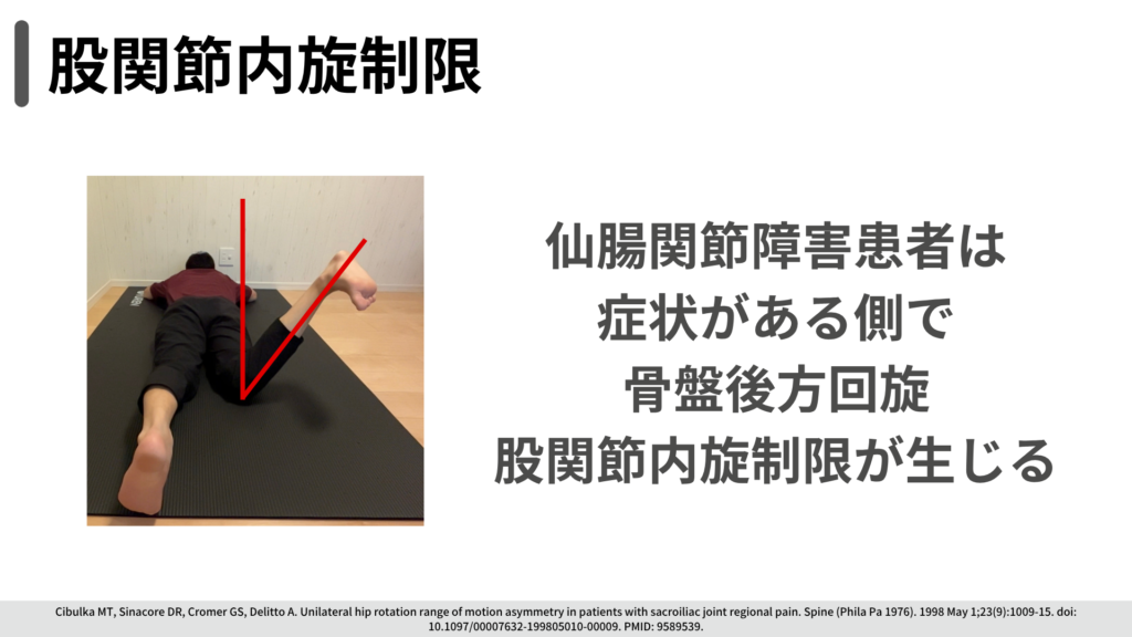 股関節内旋制限　仙腸関節障害患者は症状側で骨盤後方回旋・股関節内旋制限が生じる（Cibulka 1998）